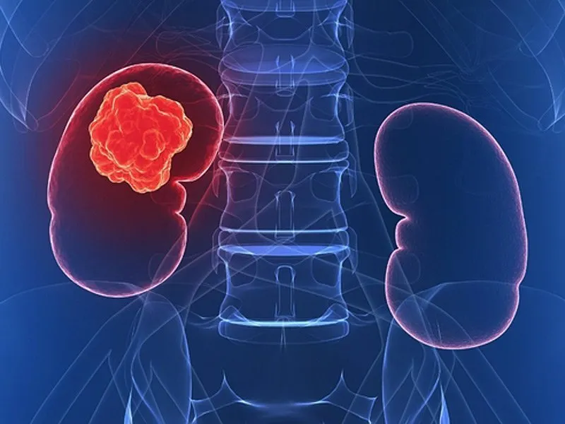 New Method Detects Kidney Cancer